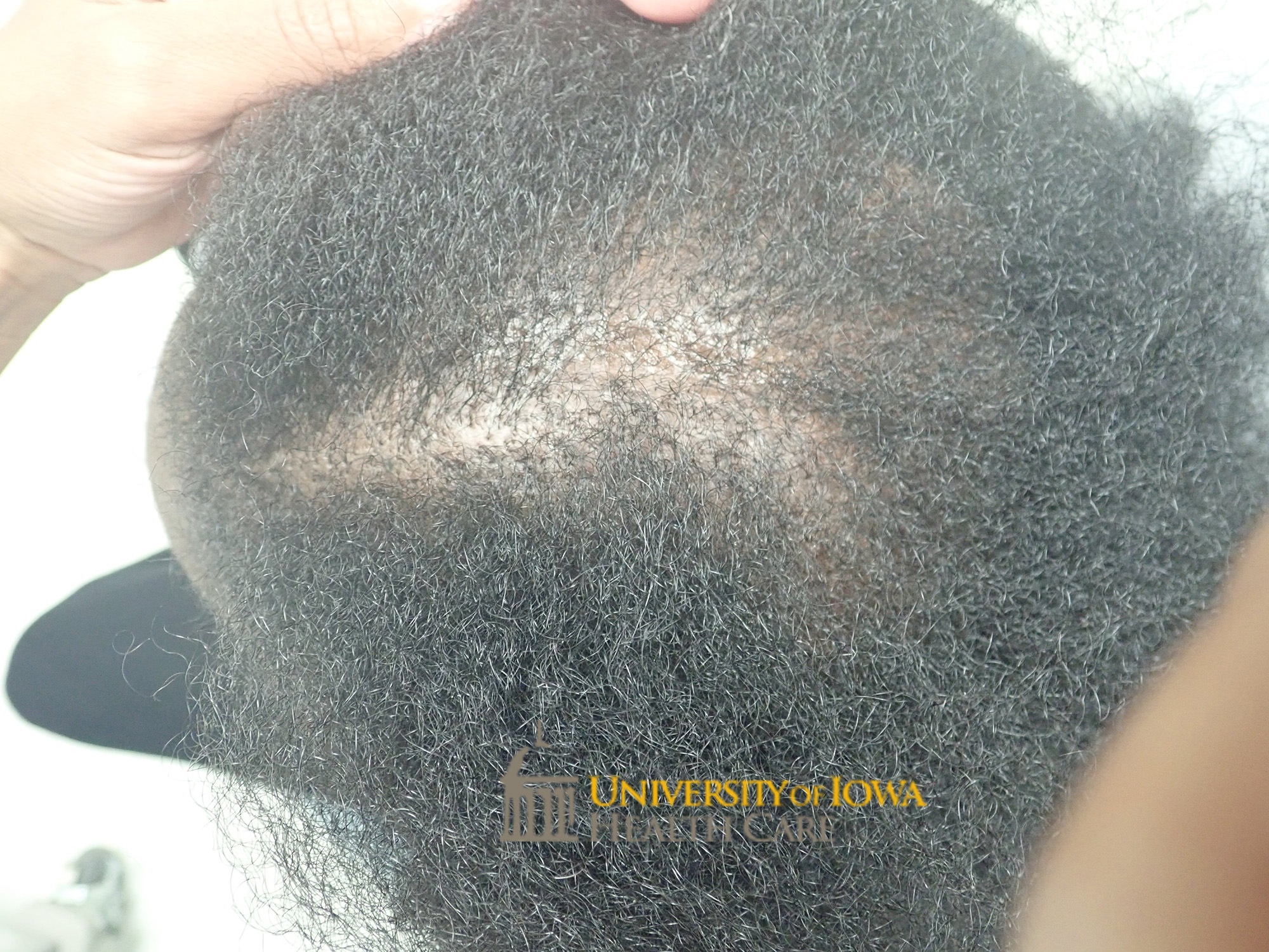 Irregular patch of scarring alopecia with some retained hair follicles on the scalp. (click images for higher resolution).